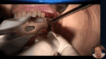Socket Grafting GIF