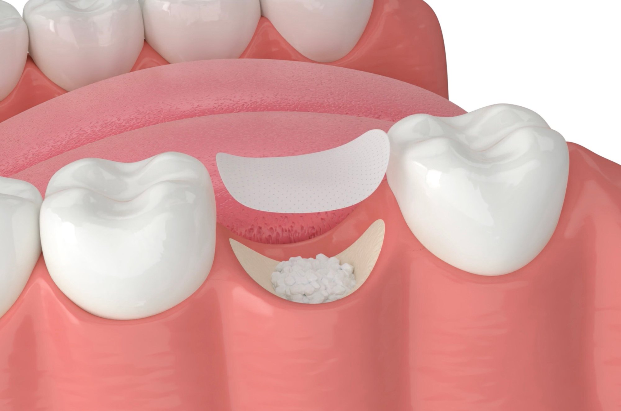 AdobeStock_482551389_bone_grafting