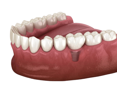 AdobeStock_544542870_Implant AdobeStock_544542870_Implant