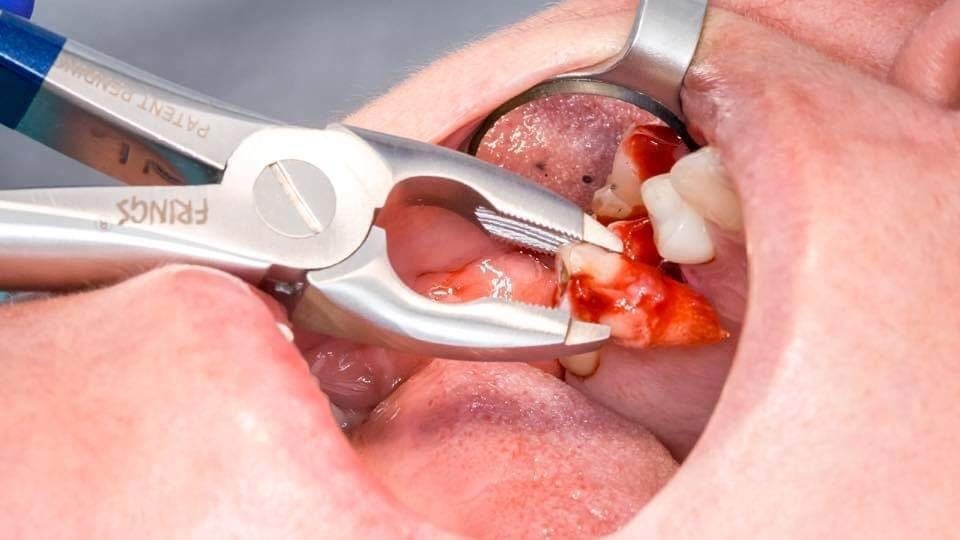 A tooth being extracted A tooth being extracted
