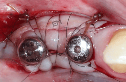Immediate Implants by EM Immediate Implants by EM