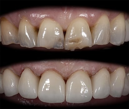 Restored Teeth Restored Teeth