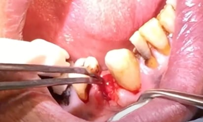 Tooth being extracted Tooth being extracted