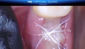 Socket Grafting Closure IMG