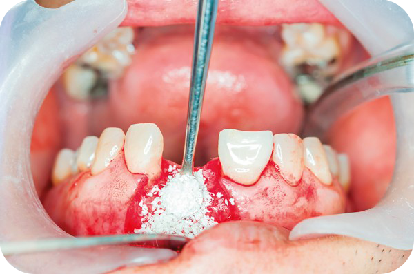 Socket Grafting Hero Landing Page