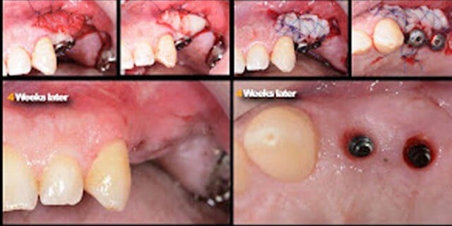 Souayah_Implant_Case copy Medium