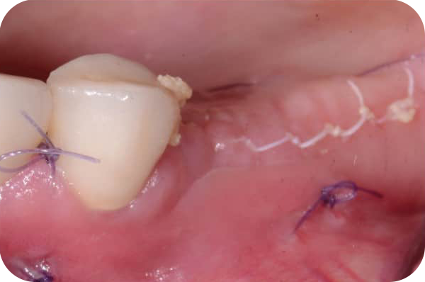Suturing Landing Page Image