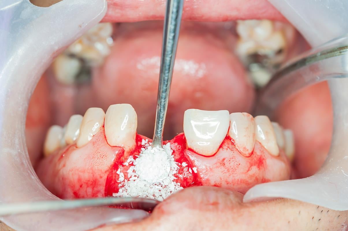 bone-grafting-2