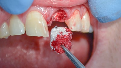 Bone Grafting Image