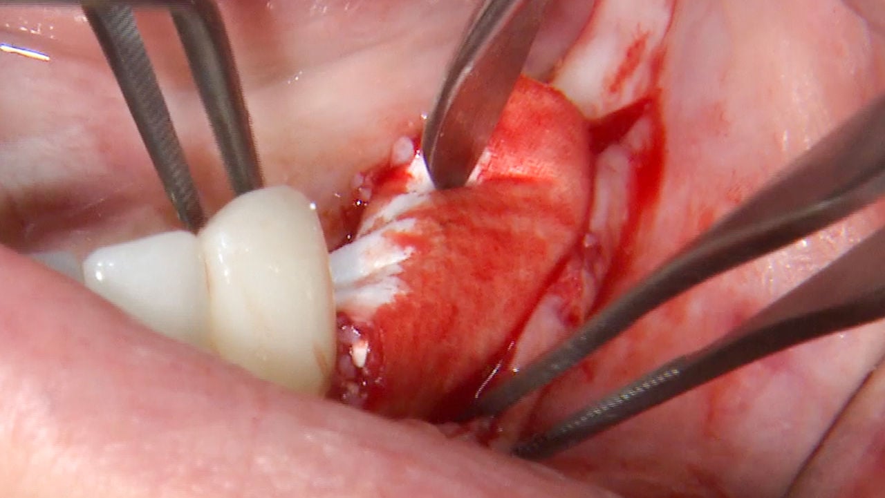 Preserving bone and promoting regeneration Preserving bone and promoting regeneration