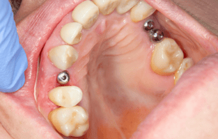 Tooth implants